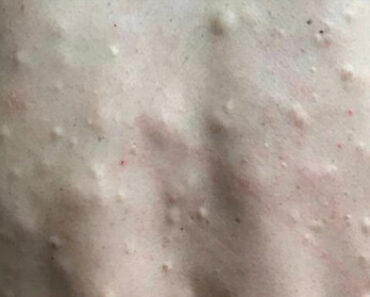 Han går till läkaren med ryggen täckt av knölar – se när hon skär hål på dem