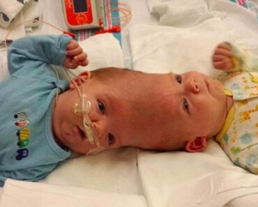 Tvillingarna föddes med sina huvuden ihop – men se dom nu efter mirakel-operationen!