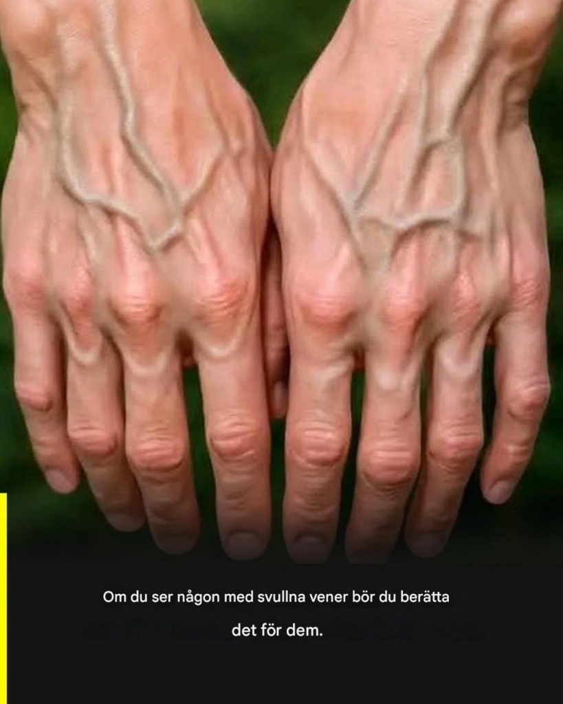 Om dina vener är synliga betyder det att du…